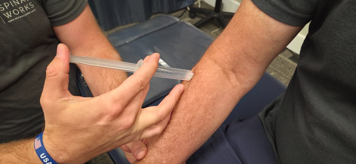 Ozone injection therapy
